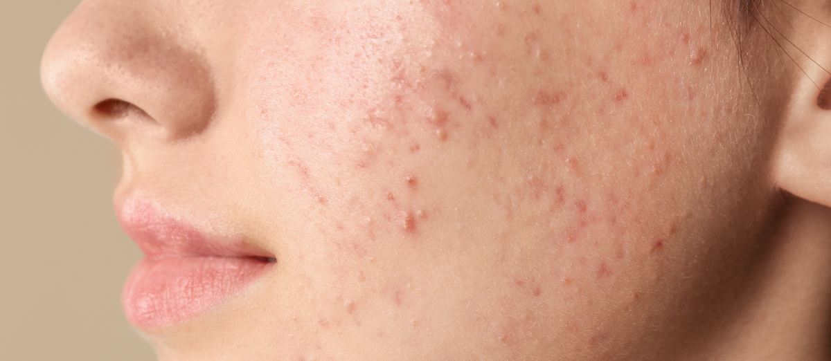 Skin Type: Acne-Prone Skin