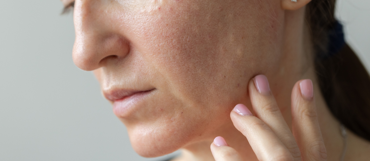 Post-procedure recovery skincare at Elume Medspa